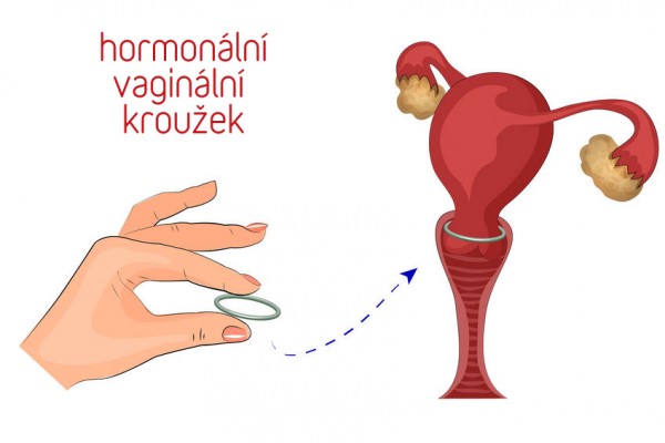 Vaginální kroužek